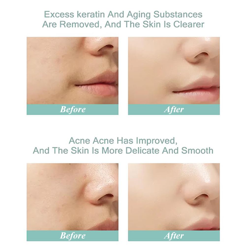 WONDER POINT Aqua Peeling Solution, Salon Professional Premium Derm...