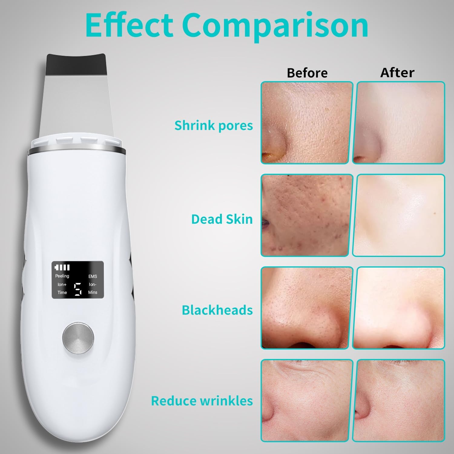 LITUEPET Espátula para la piel facial, herramienta removedora de pu...