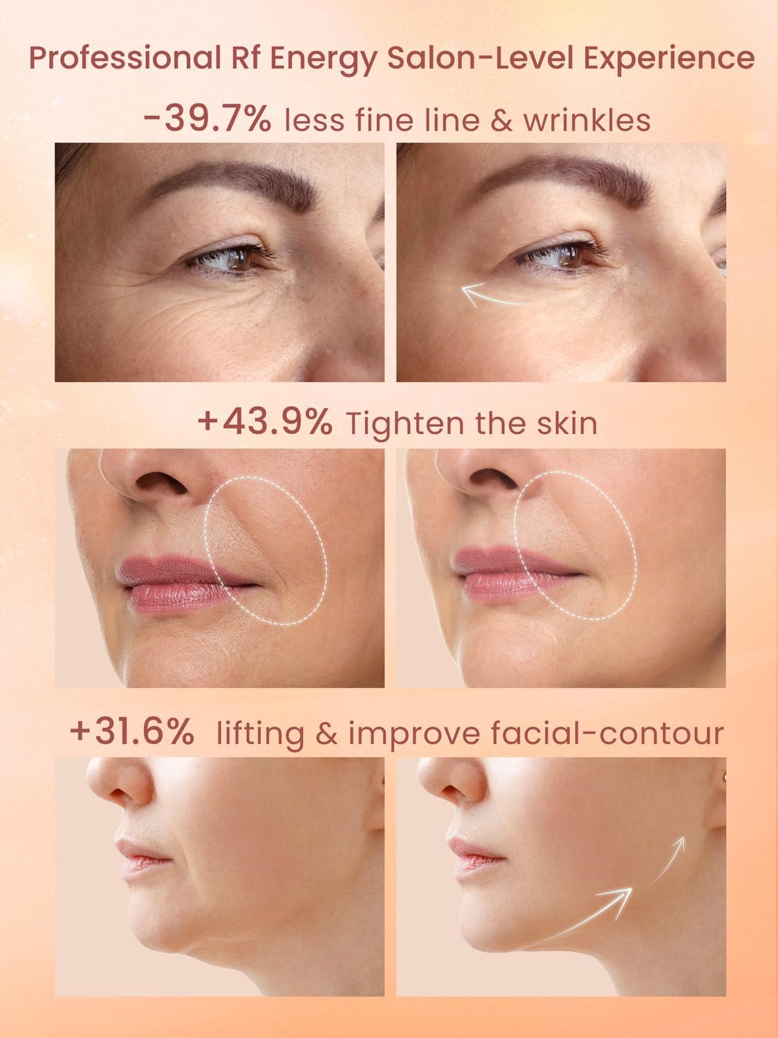 Dispositivo facial de radiofrecuencia RF, máquina RF de 1 MHz para...
