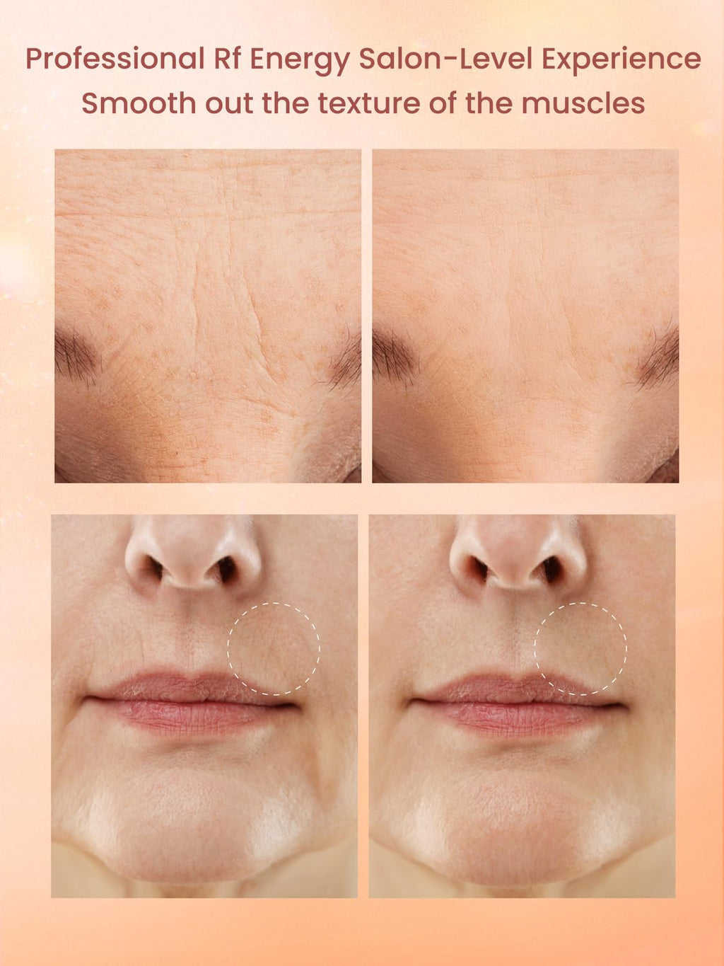 Dispositivo facial de radiofrecuencia RF, máquina RF de 1 MHz para...