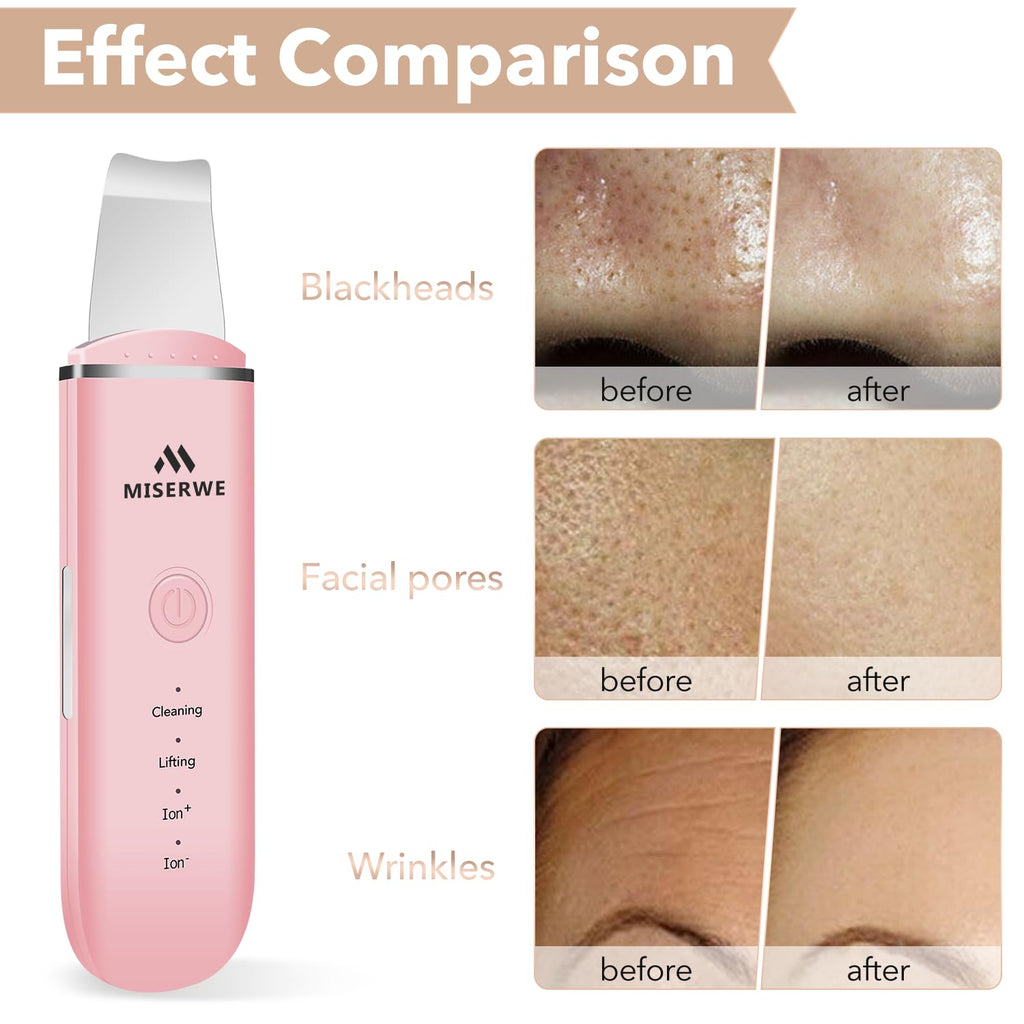 MISERWE - Espátula facial para la piel, limpiador de poros con 4 mo...
