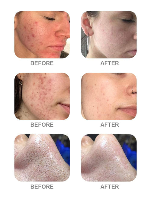 AS1 SA2 AO3 Aqua Peeling Solution Premium Salon Professional Dermoa...