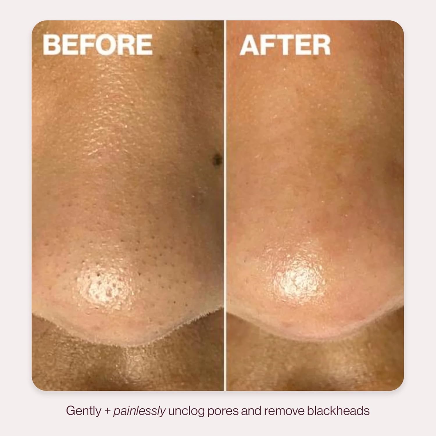 DERMAFLASH DERMAPORE+ Dispositivo de cuidado de la piel, extractor...