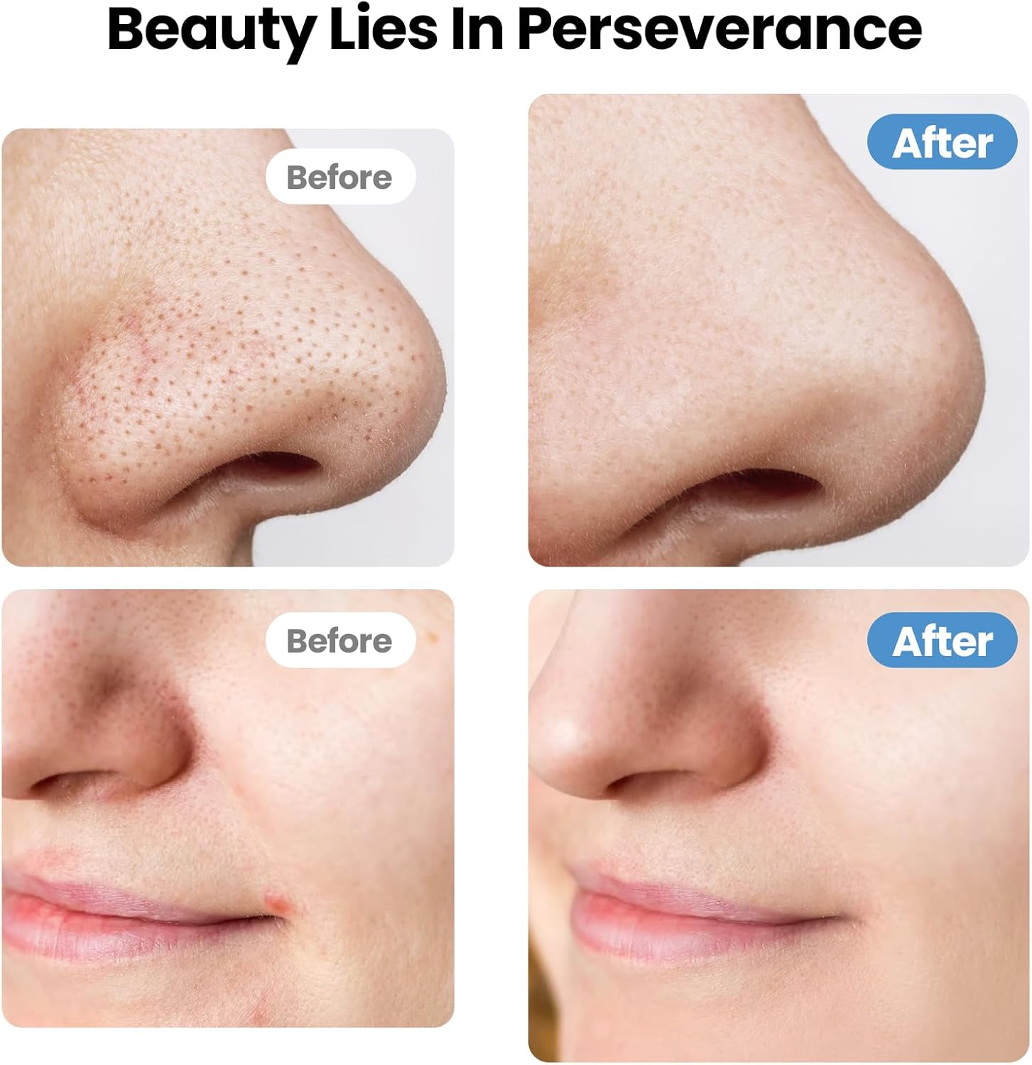 UNIWA Espátula facial ultrasónica para limpiar la piel, limpiador d...