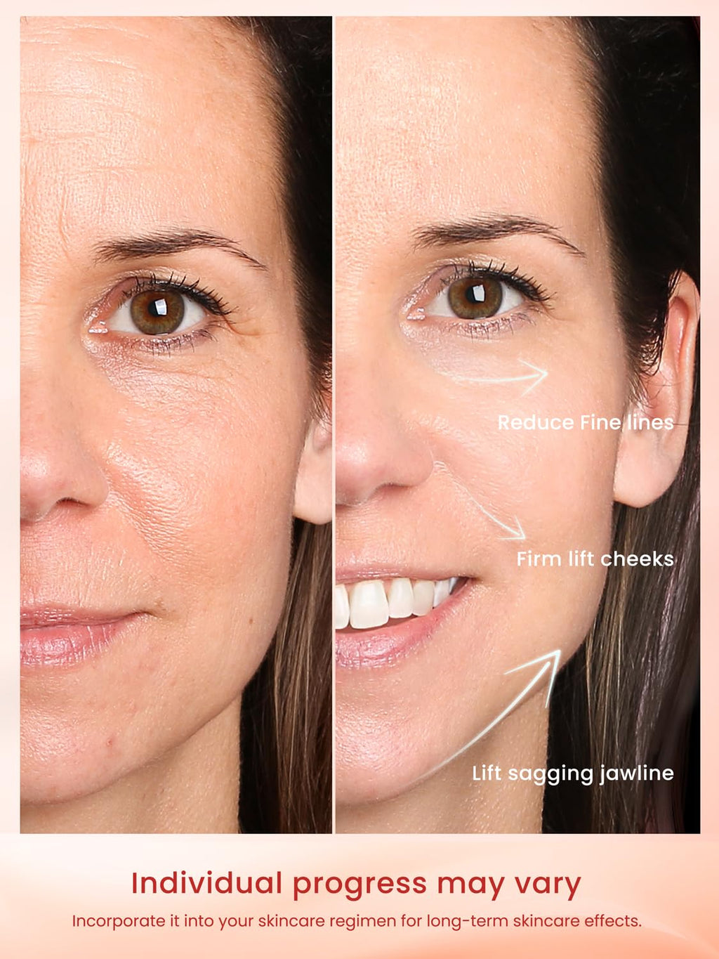 Dispositivo facial de radiofrecuencia RF, máquina RF de 1 MHz para...