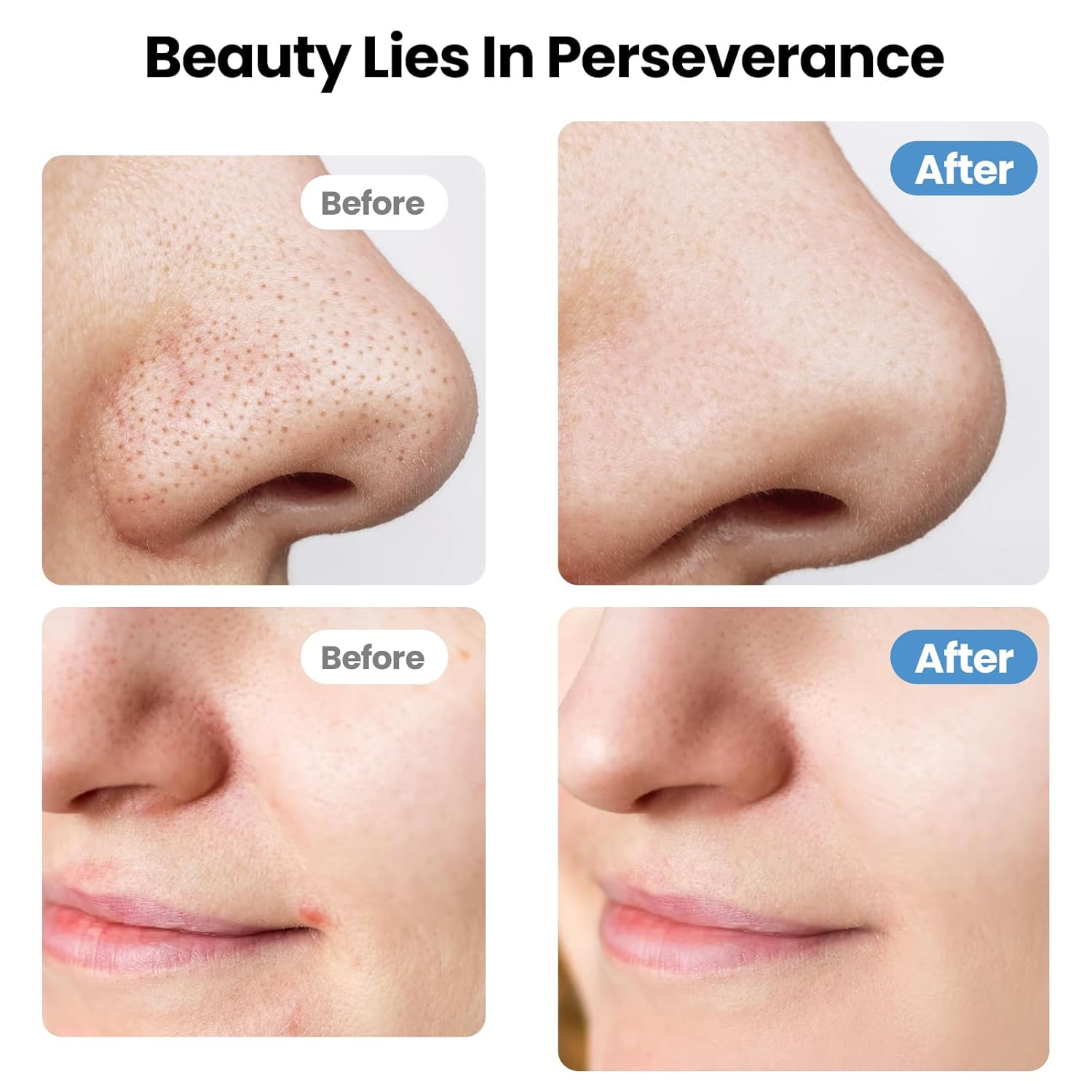 UNIWA Espátula facial para limpiar la piel, limpiador de poros, her...