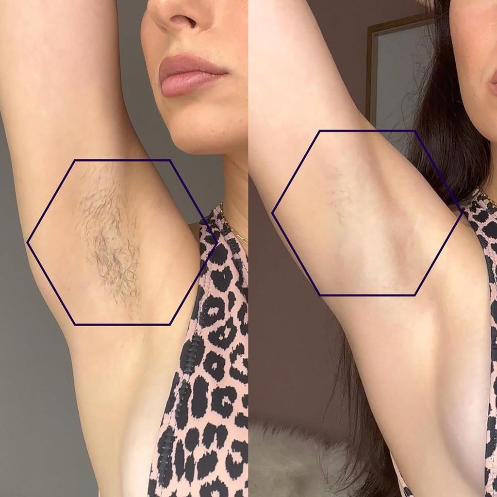 MICHAEL TODD Beauty: dispositivo de depilación láser IPL LUMOS para...