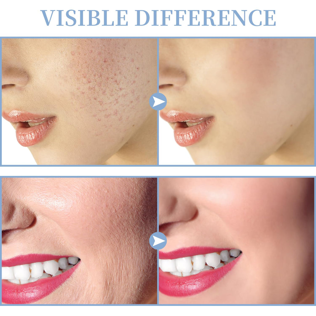 Máquina Facial de Alta Frecuencia - TUMAKOU Máquina Portátil de Man...