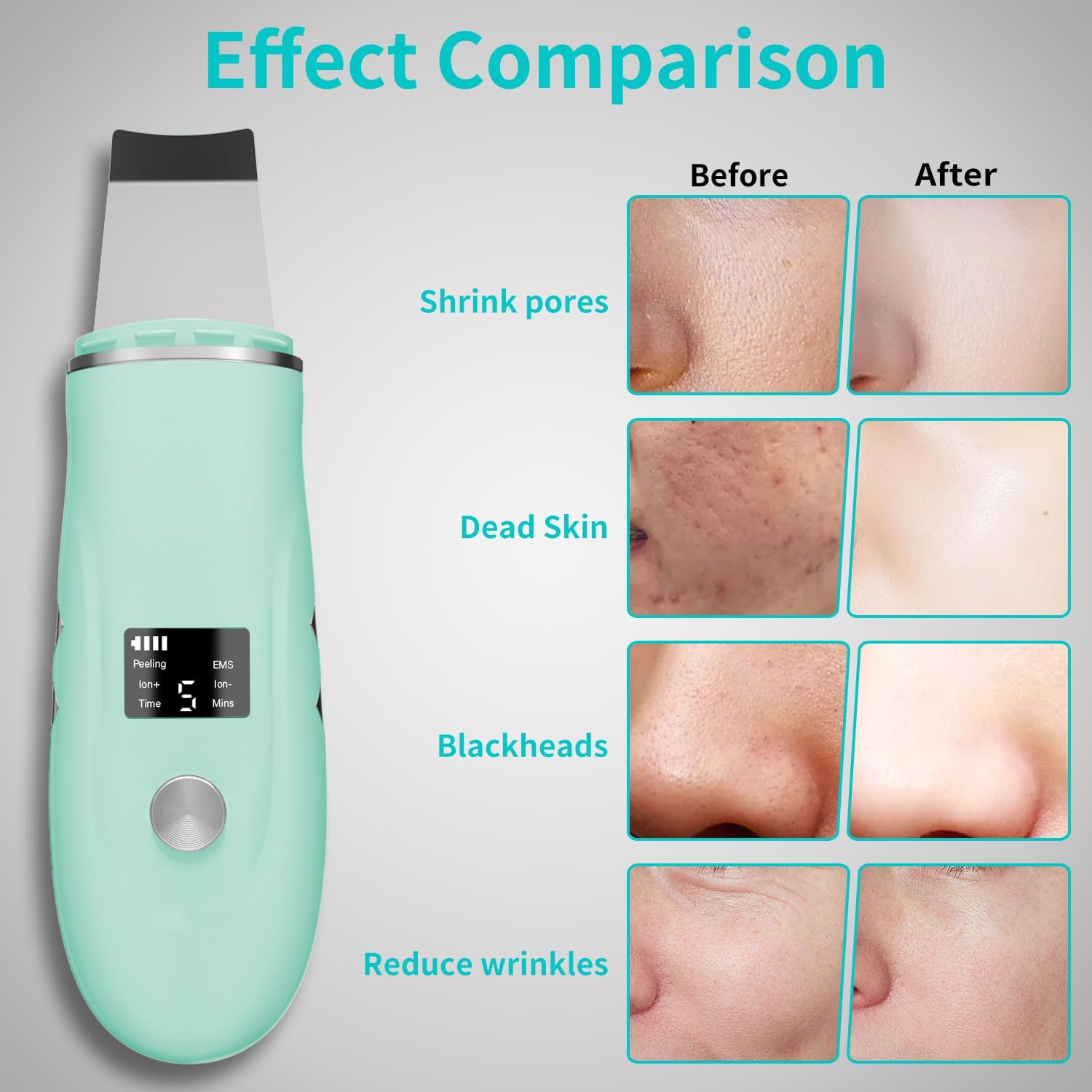 Espátula facial para limpieza profunda - Removedor de puntos negros...