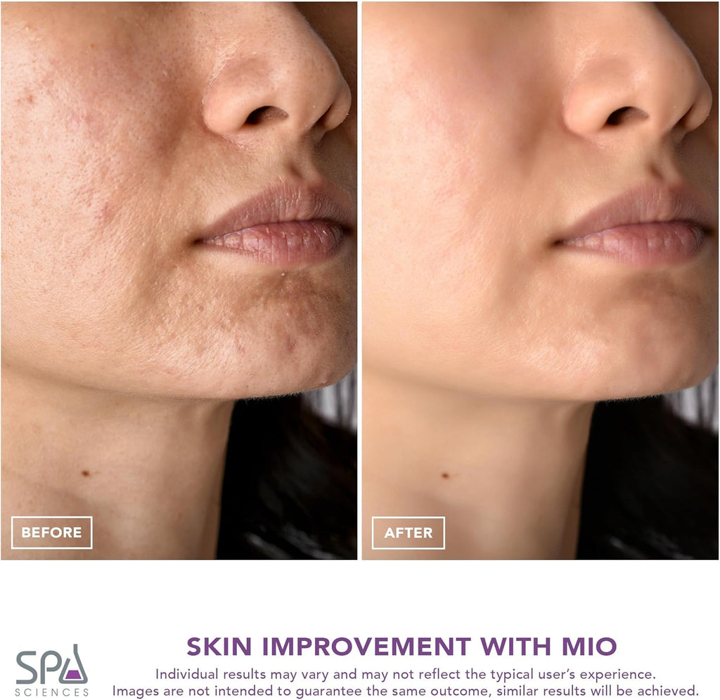 Spa Sciences - MIO - Eliminador de puntos negros de microdermoabras...