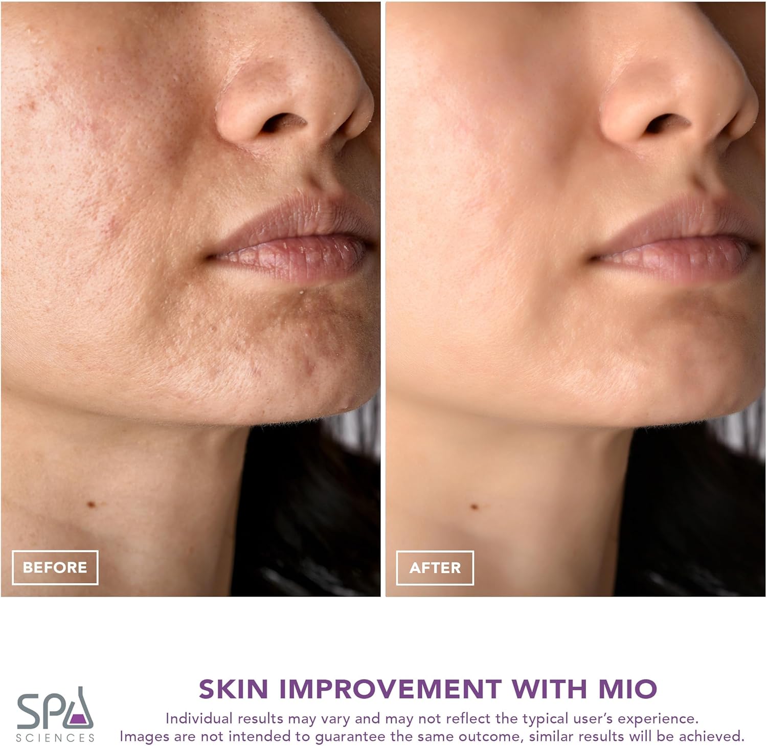 Spa Sciences - MIO - Eliminador de puntos negros de microdermoabras...